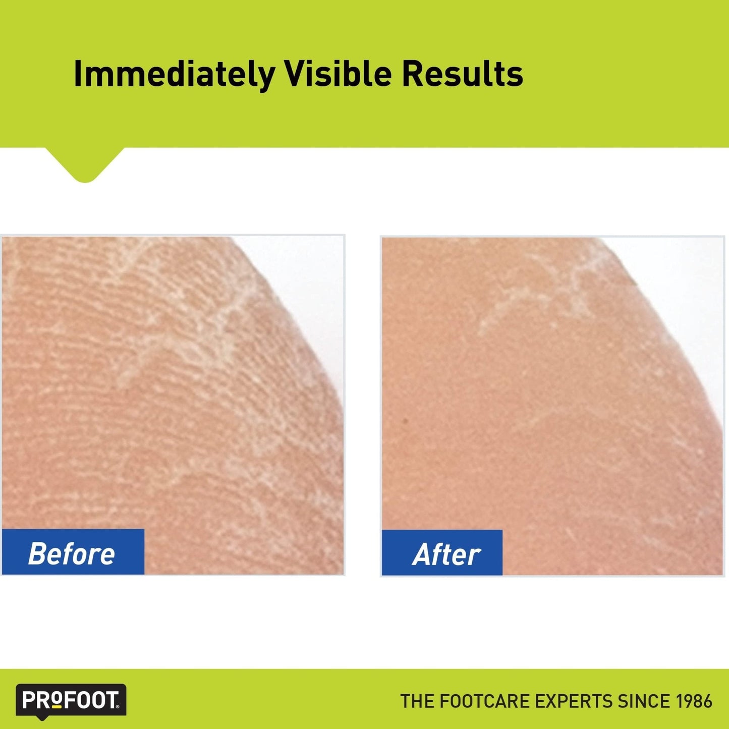 ProFoot Care Heel Rescue Foot Cream | For Cracked, Calloused, Scaly Or Dry Feet | 16 Oz-454g - Ome's Beauty Mart