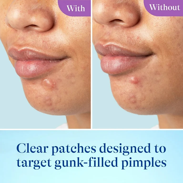 Differin Acne-Prone Pimple Patches | Formulated with Salicylic Acid and Centella | Fast Triple Action Power Patch for Day & Night | 36 Patches