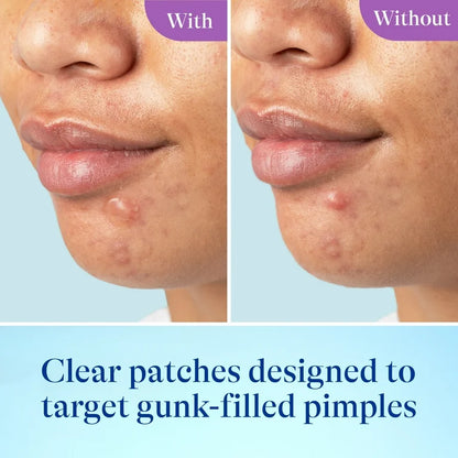 Differin Acne-Prone Pimple Patches | Formulated with Salicylic Acid and Centella | Fast Triple Action Power Patch for Day & Night | 36 Patches