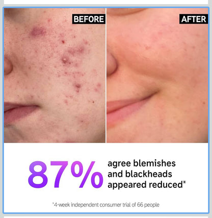 The INKEY List Salicylic Acid Cleanser | Face Wash for Blemishes, Blackheads, Oily Skin and Breakouts | Non-Drying Facial Cleanser Safe for All Skin Types | 150ml; Exp 01/2026