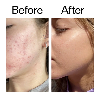 Inkey List 10% Niacinamide Serum | Visibly Reduces Excess oil, Blemishes & Enlarged Pores | 30ml